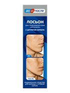Лосьон «До и После» Анти-Акне для проблемной кожи, 200 мл - Фото 5