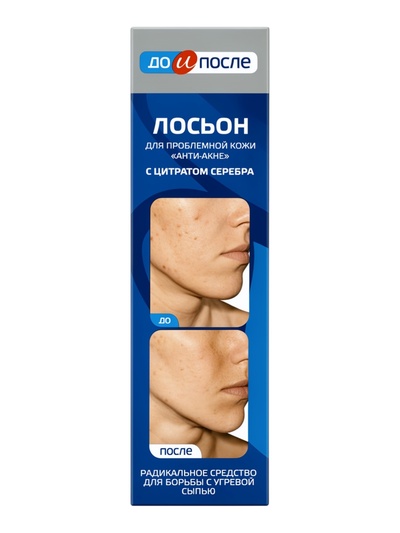 Лосьон «До и После» Анти-Акне для проблемной кожи, 200 мл