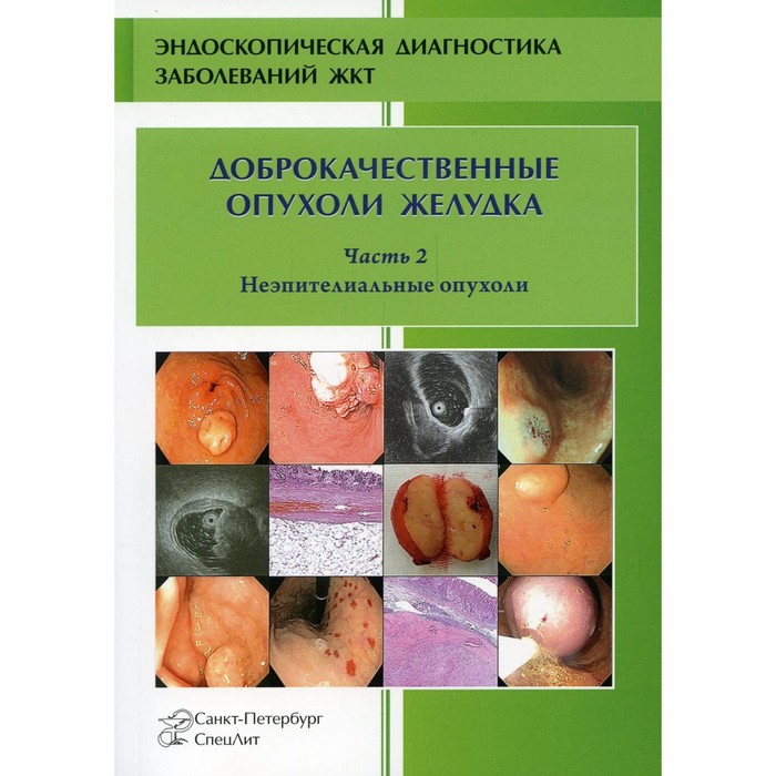 Стадии развития опухоли желудка. Опухоли желудка отзывы. Опухоли желудка отзывы. Экзофитная опухоль желудка рентген. Опухоли желудка отзывы.