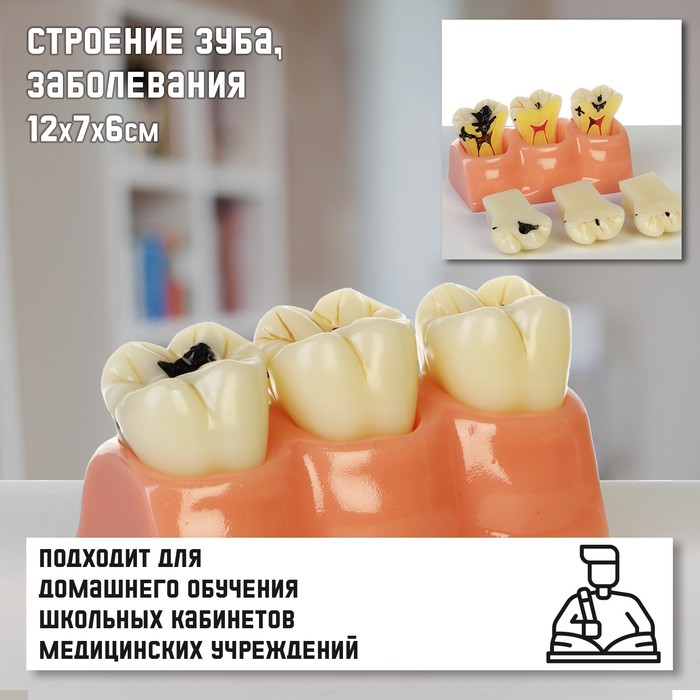 Макет "Строение зуба, заболевания", 12*7*6см - Фото 1