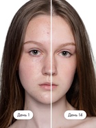 Гель для умывания для проблемной кожи SEMILY против акне, очищающий, 200 мл - Фото 5